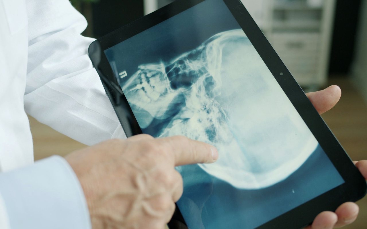 Aneurisma cerebral: síntomas, diagnóstico y tratamiento neuroquirúrgico en Tijuana