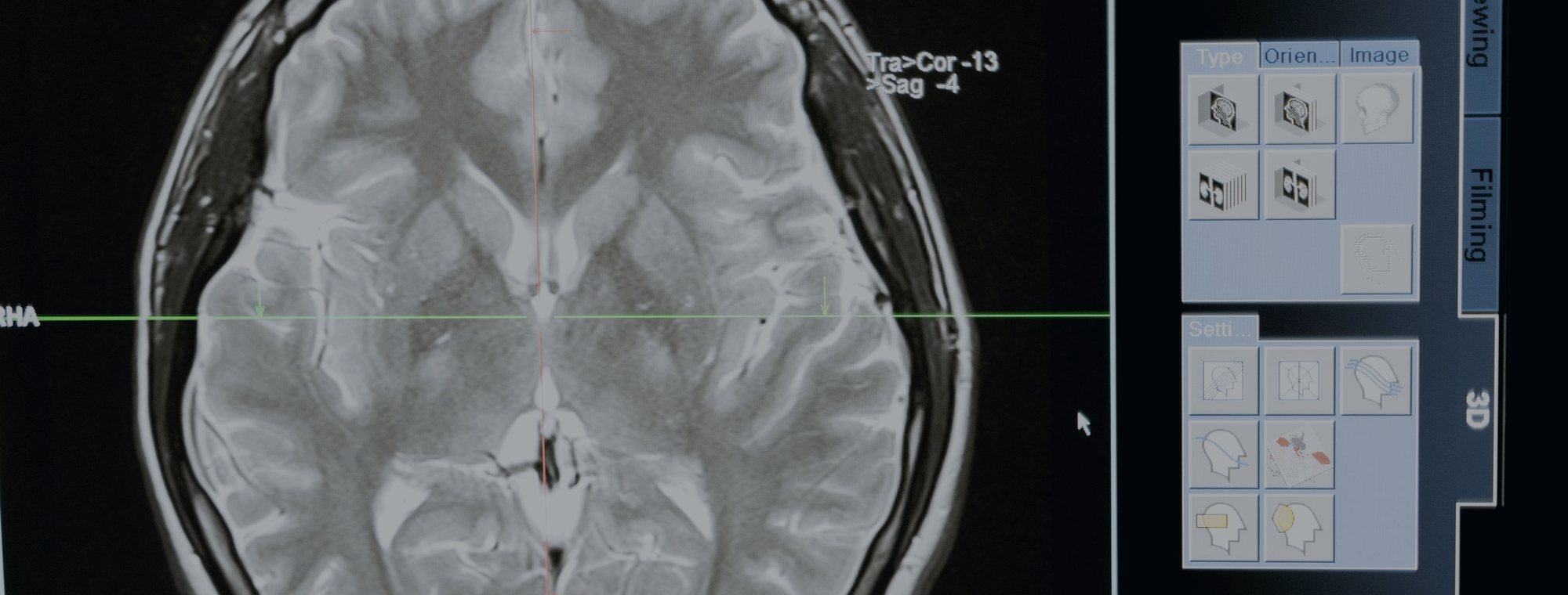 Brain surgery in Tijuana — Dr. Carlos A. Noreña Osterroth