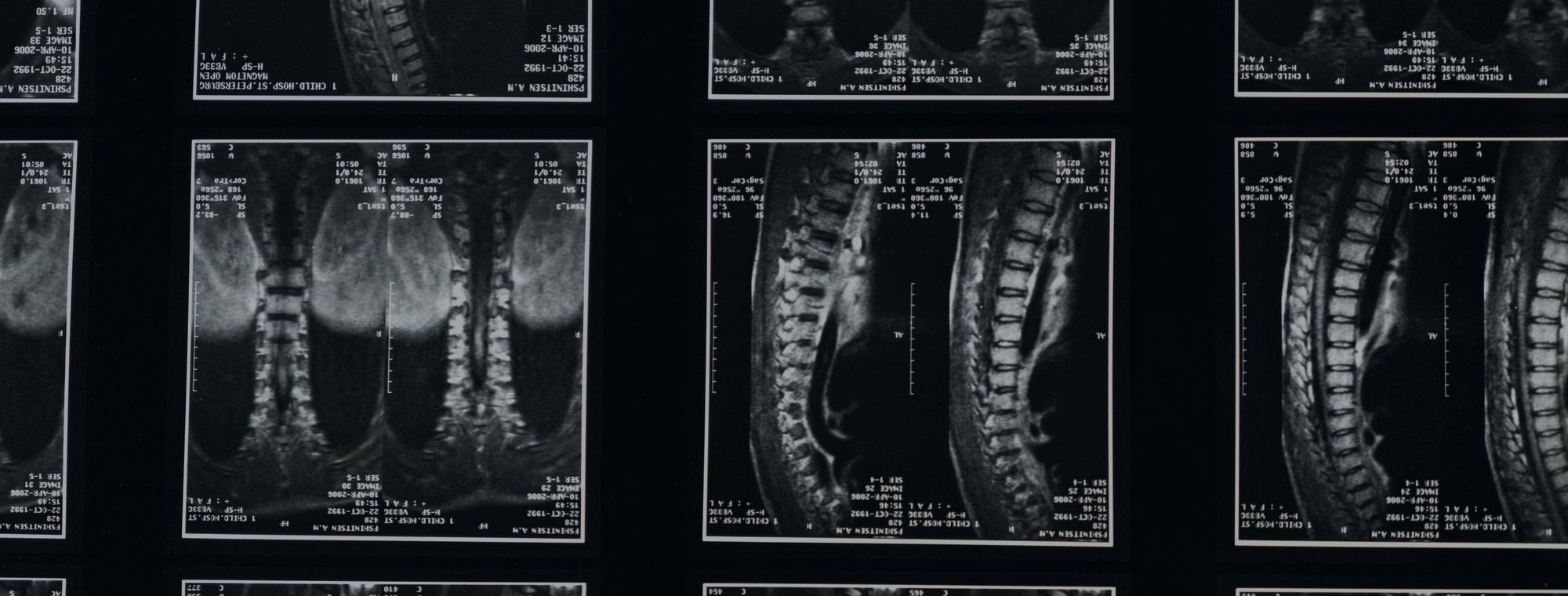 Spine surgery in Tijuana — Dr. Carlos A. Noreña Osterroth