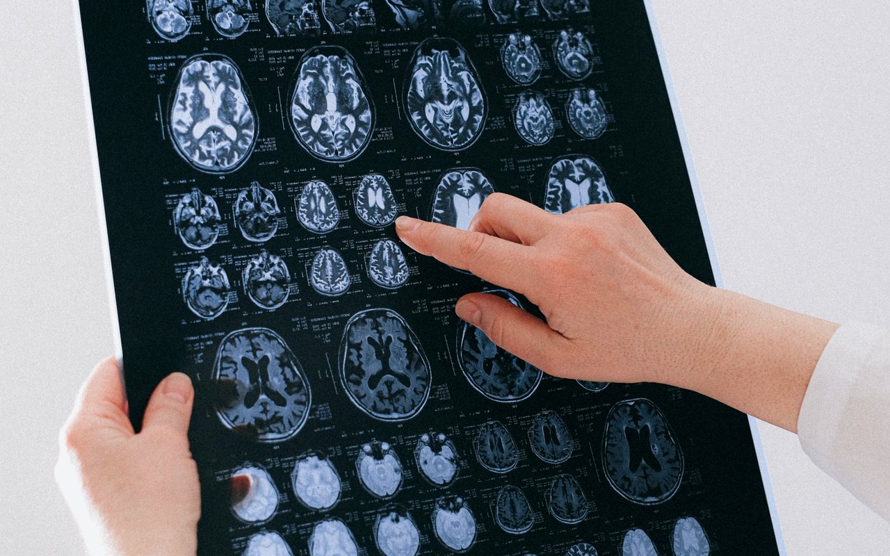 Microcirugía de tumor cerebral en Tijuana con el Dr. Carlos A. Noreña Osterroth