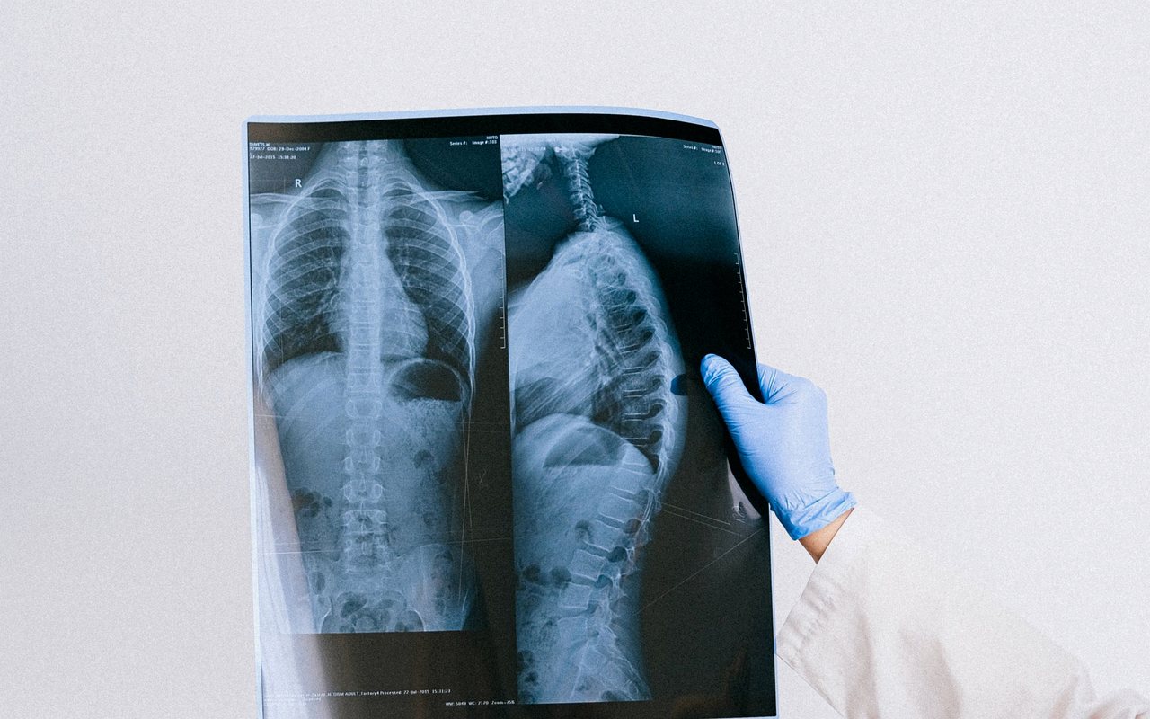 Cirugía de tumor de columna en Tijuana con el Dr. Carlos A. Noreña Osterroth